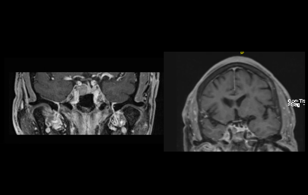 Acromegaly treatment