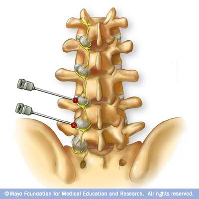 Illustration showing placement of needles 
