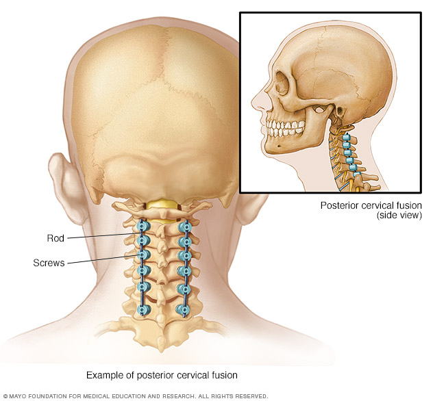 Hardware used to fuse spine from back of neck