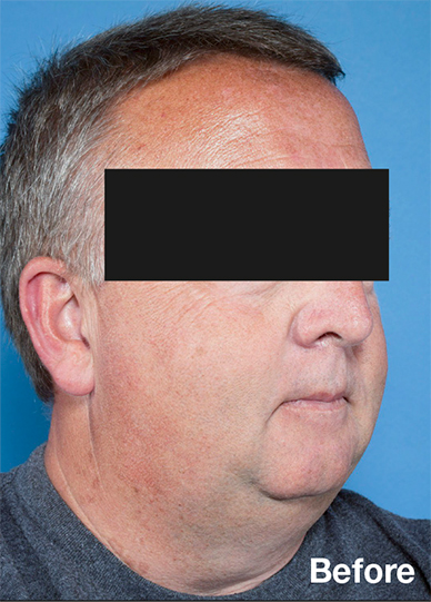 Appearance before maxillomandibular advancement surgery